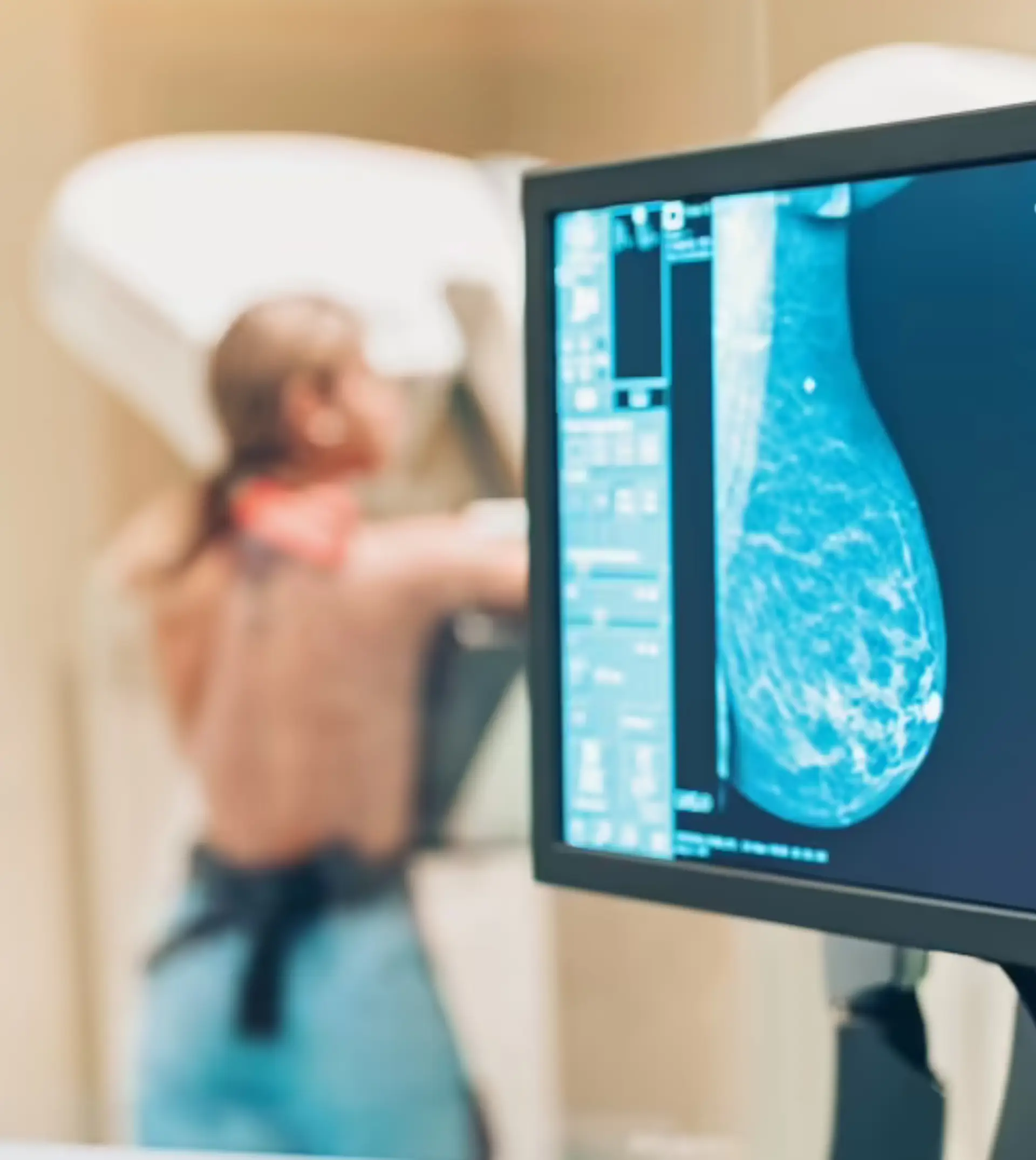 mammography