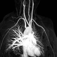 angiogram