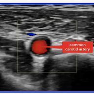 carotid