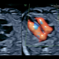 fetal_echo
