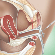 follicular