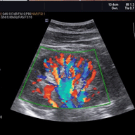 kidney_doppler