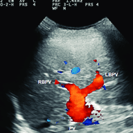 liver_doppler
