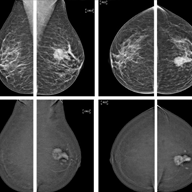 mamogram_mri