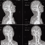 neck_ct