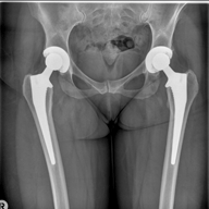 pelvis