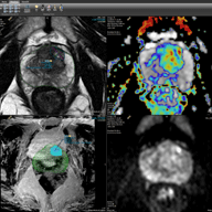 prostate