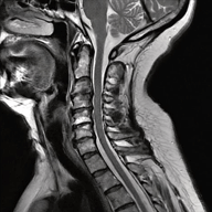 spinal_mri