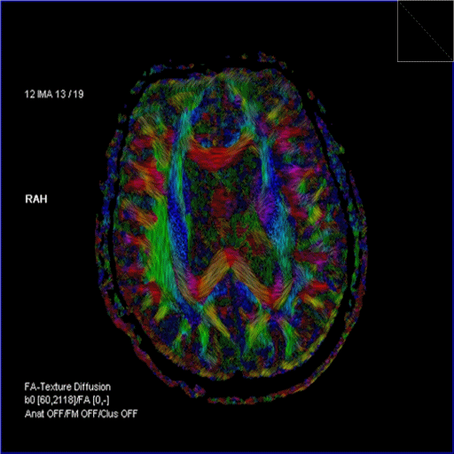 tecto_mri