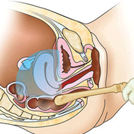 transvaginal